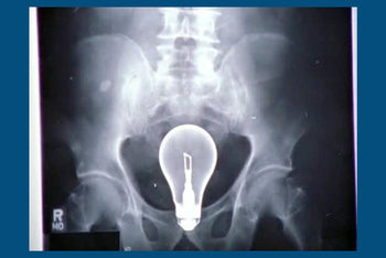 Things People Have Put Up Their Butts: Doctor Advice